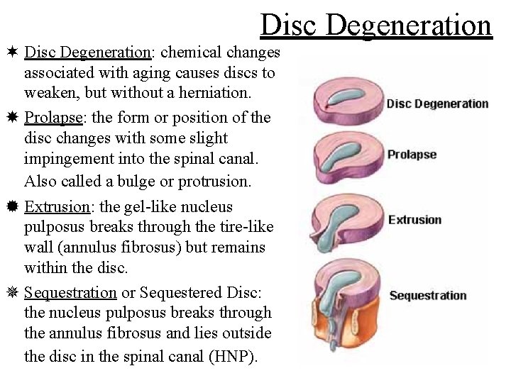 Disc Degeneration ¬ Disc Degeneration: chemical changes associated with aging causes discs to weaken,