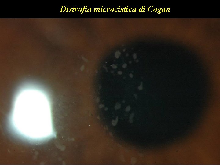 Distrofia microcistica di Cogan 