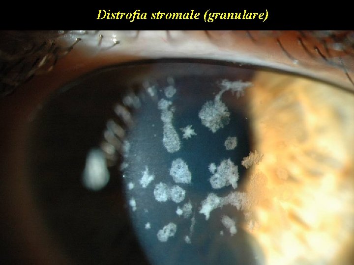 Distrofia stromale (granulare) 