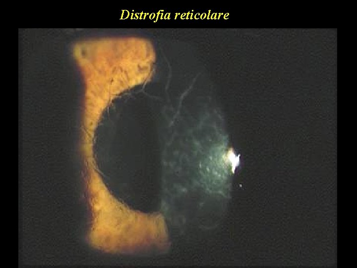 Distrofia reticolare 