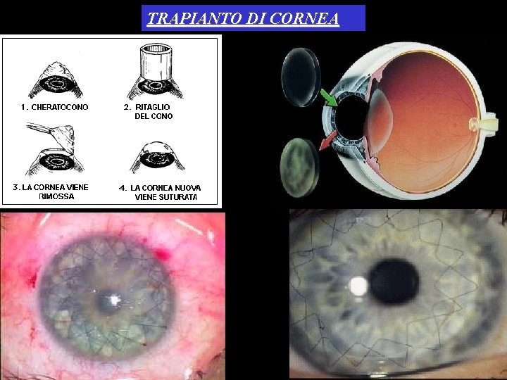 TRAPIANTO DI CORNEA 