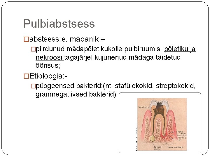 Pulbiabstsess �abstsess: e. mädanik – �piirdunud mädapõletikukolle pulbiruumis, põletiku ja nekroosi tagajärjel kujunenud mädaga