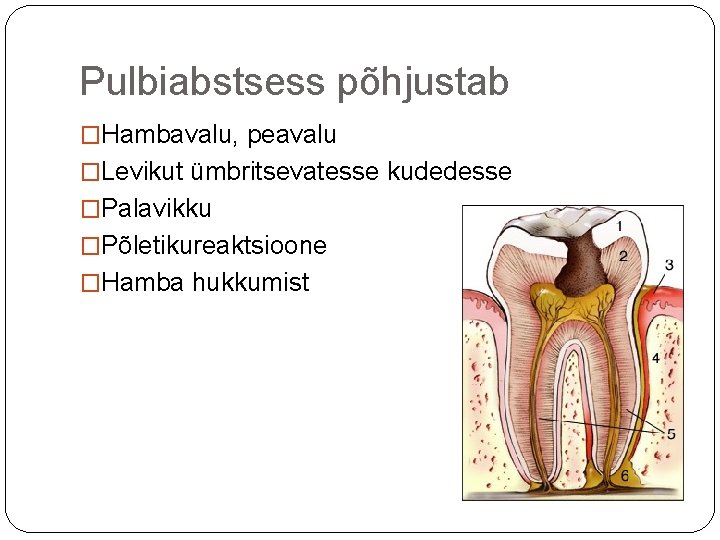 Pulbiabstsess põhjustab �Hambavalu, peavalu �Levikut ümbritsevatesse kudedesse �Palavikku �Põletikureaktsioone �Hamba hukkumist 