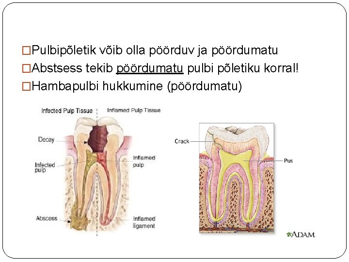 �Pulbipõletik võib olla pöörduv ja pöördumatu �Abstsess tekib pöördumatu pulbi põletiku korral! �Hambapulbi hukkumine