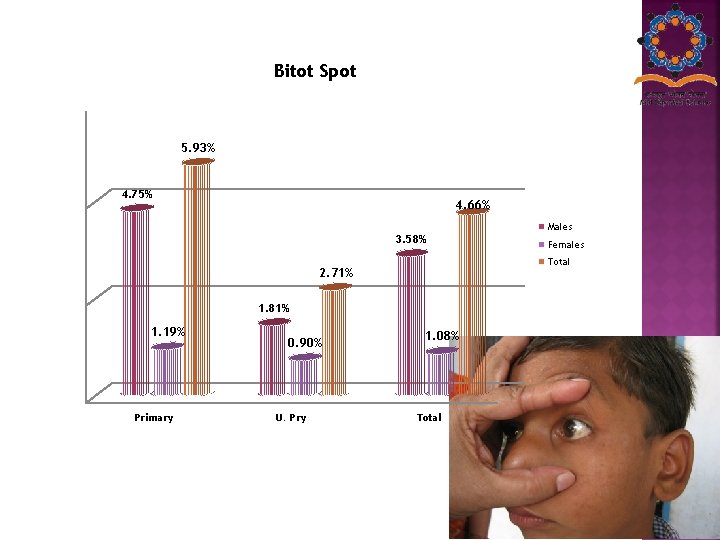 Bitot Spot 5. 93% 4. 75% 4. 66% 3. 58% 1. 81% Primary 0.