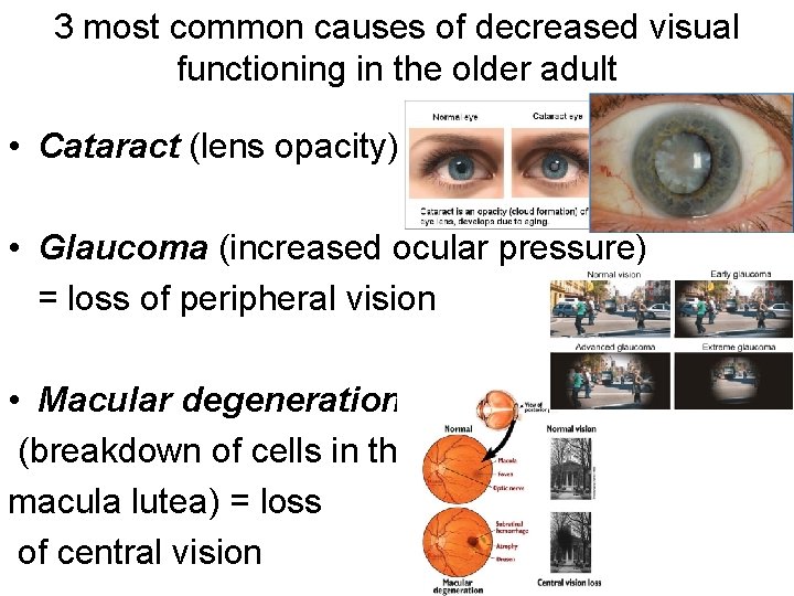 3 most common causes of decreased visual functioning in the older adult • Cataract