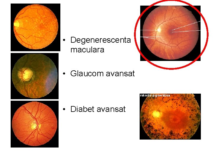  • Degenerescenta maculara • Glaucom avansat • Diabet avansat 