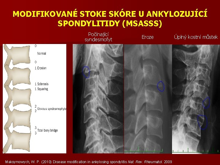 MODIFIKOVANÉ STOKE SKÓRE U ANKYLOZUJÍCÍ SPONDYLITIDY (MSASSS) Počínající syndesmofyt Eroze Maksymowych, W. P. (2010)