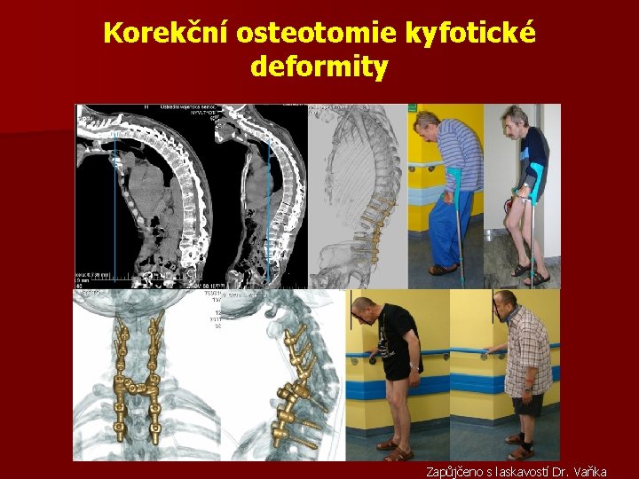 Korekční osteotomie kyfotické deformity Zapůjčeno s laskavostí Dr. Vaňka 