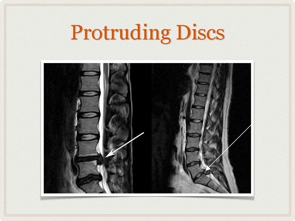 Protruding Discs 