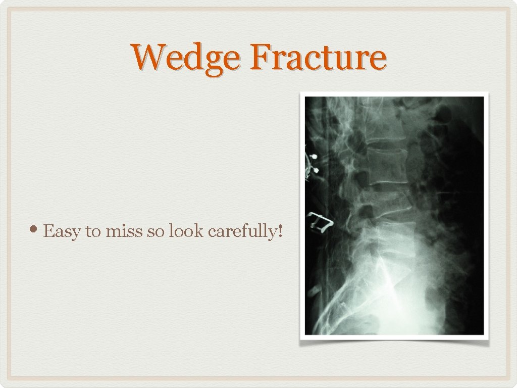 Wedge Fracture • Easy to miss so look carefully! 