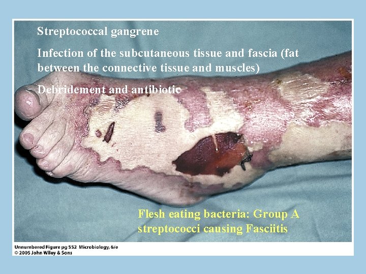 Streptococcal gangrene Infection of the subcutaneous tissue and fascia (fat between the connective tissue