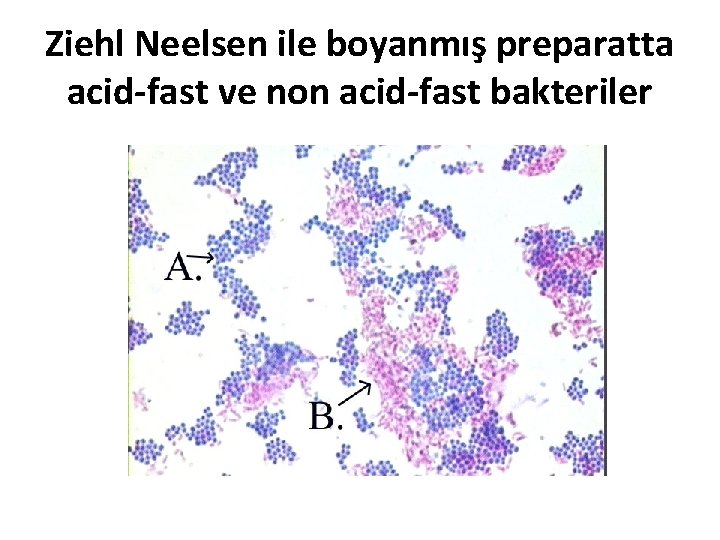 Ziehl Neelsen ile boyanmış preparatta acid-fast ve non acid-fast bakteriler 