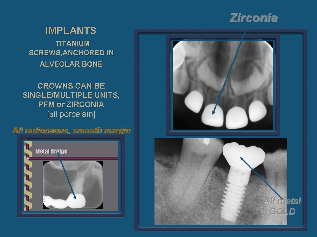 Zirconia IMPLANTS TITANIUM SCREWS, ANCHORED IN ALVEOLAR BONE CROWNS CAN BE SINGLE/MULTIPLE UNITS, PFM
