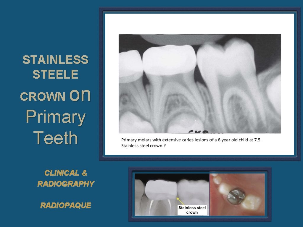 STAINLESS STEELE CROWN on Primary Teeth CLINICAL & RADIOGRAPHY RADIOPAQUE 