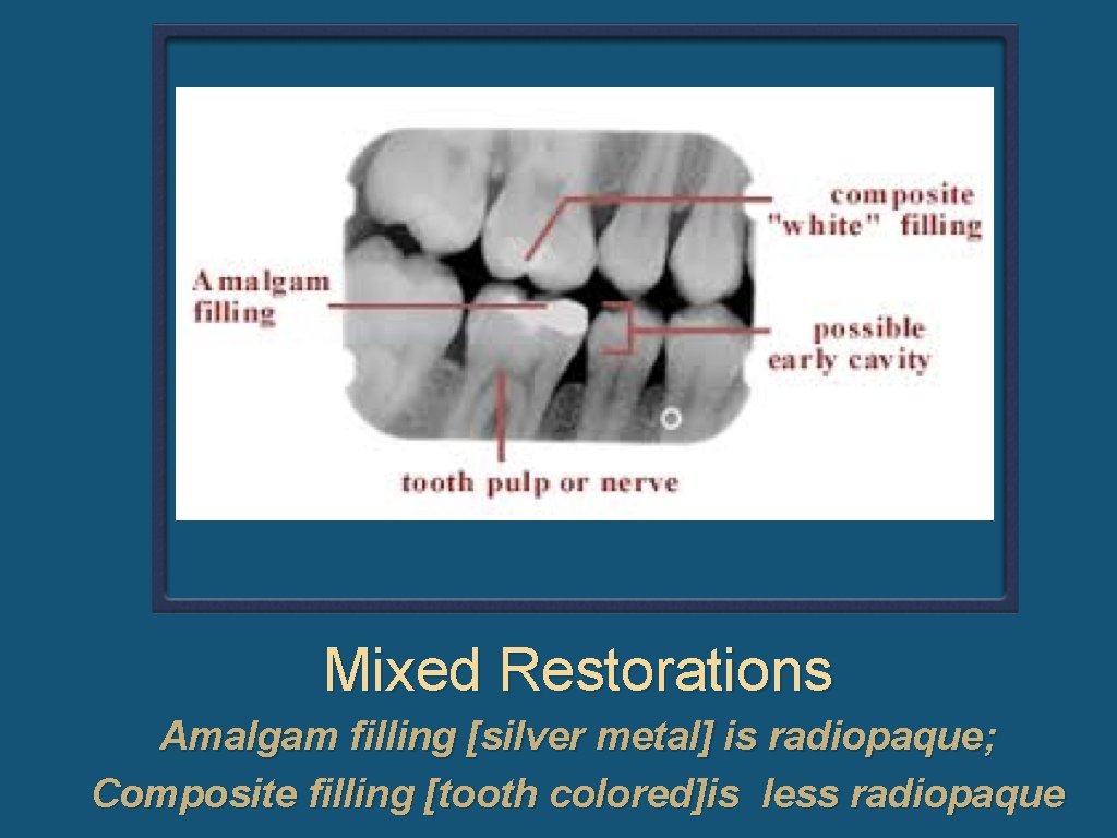 Mixed Restorations Amalgam filling [silver metal] is radiopaque; Composite filling [tooth colored]is less radiopaque