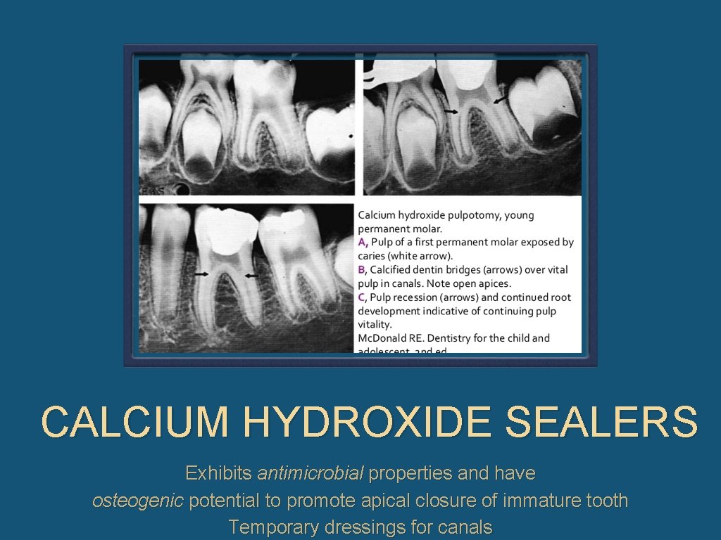 CALCIUM HYDROXIDE SEALERS Exhibits antimicrobial properties and have osteogenic potential to promote apical closure