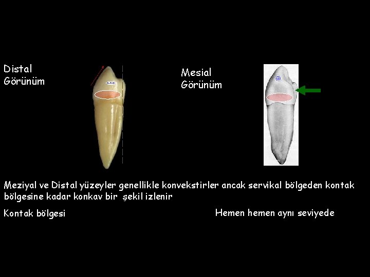 Distal Görünüm Mesial Görünüm Meziyal ve Distal yüzeyler genellikle konvekstirler ancak servikal bölgeden kontak