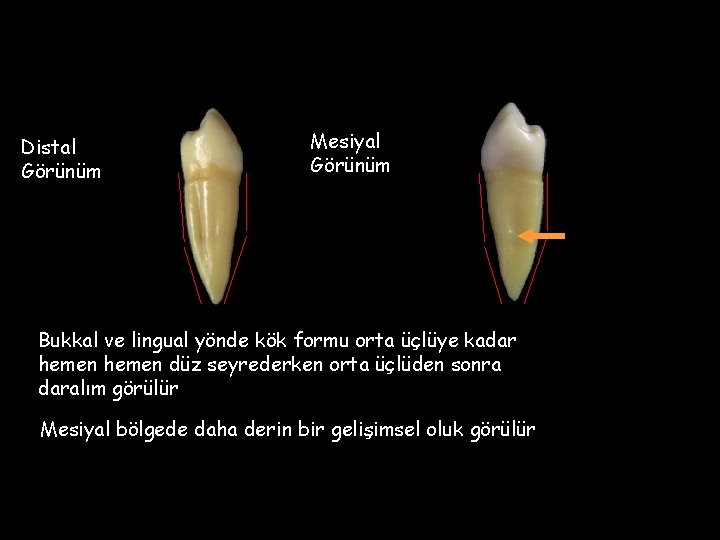 Distal Görünüm Mesiyal Görünüm Bukkal ve lingual yönde kök formu orta üçlüye kadar hemen