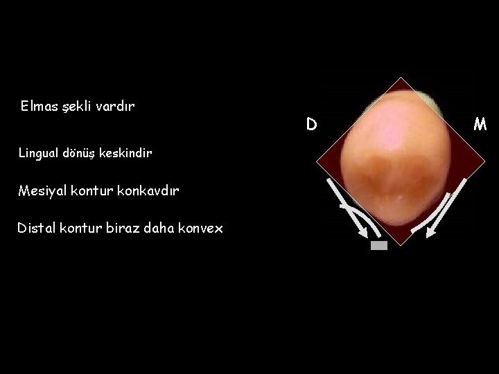 Elmas şekli vardır Lingual dönüş keskindir Mesiyal kontur konkavdır Distal kontur biraz daha konvex