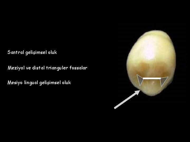 Santral gelişimsel oluk Meziyal ve distal trianguler fossalar Mesiyo lingual gelişimsel oluk 