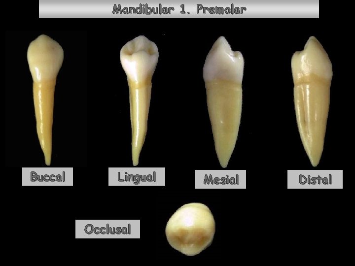 Mandibular 1. Premolar Buccal Lingual Occlusal Mesial Distal 