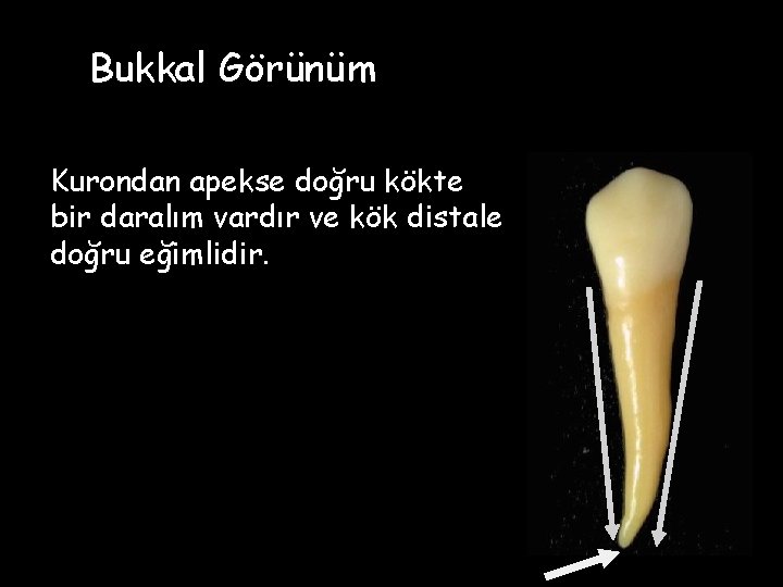 Bukkal Görünüm Kurondan apekse doğru kökte bir daralım vardır ve kök distale doğru eğimlidir.