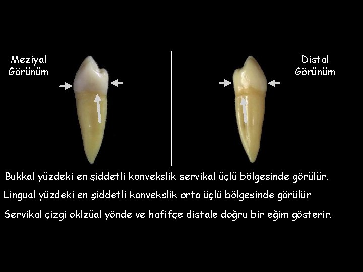 Meziyal Görünüm Distal Görünüm Bukkal yüzdeki en şiddetli konvekslik servikal üçlü bölgesinde görülür. Lingual