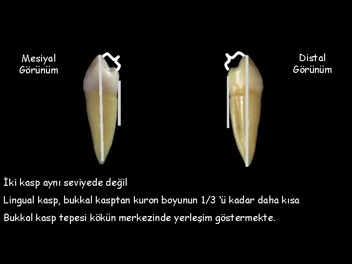 Mesiyal Görünüm Distal Görünüm İki kasp aynı seviyede değil Lingual kasp, bukkal kasptan kuron