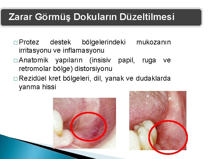 Zarar Görmüş Dokuların Düzeltilmesi � Protez destek bölgelerindeki mukozanın irritasyonu ve inflamasyonu � Anatomik