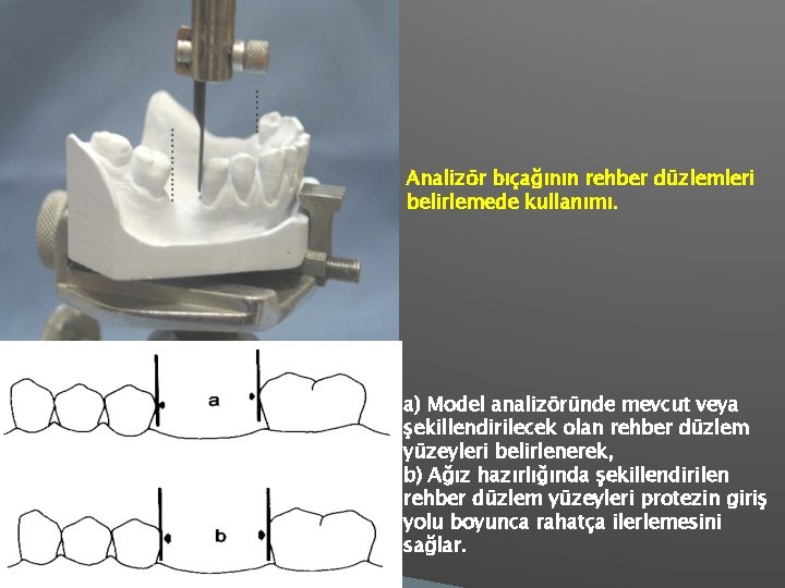 Analizör bıçağının rehber düzlemleri belirlemede kullanımı. a) Model analizöründe mevcut veya şekillendirilecek olan rehber