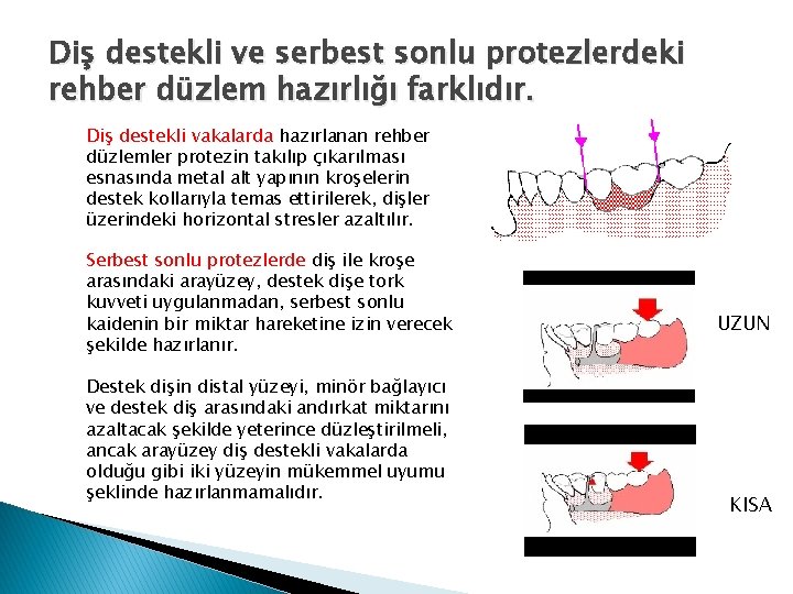 Diş destekli ve serbest sonlu protezlerdeki rehber düzlem hazırlığı farklıdır. Diş destekli vakalarda hazırlanan