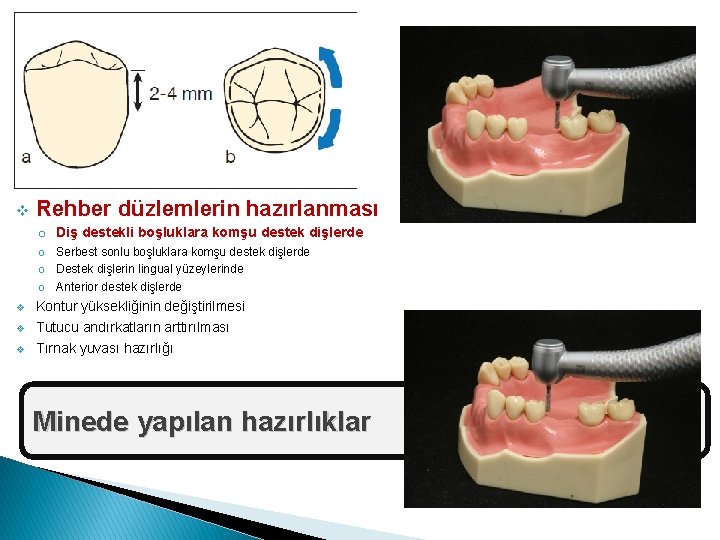 v Rehber düzlemlerin hazırlanması o Diş destekli boşluklara komşu destek dişlerde o Serbest sonlu