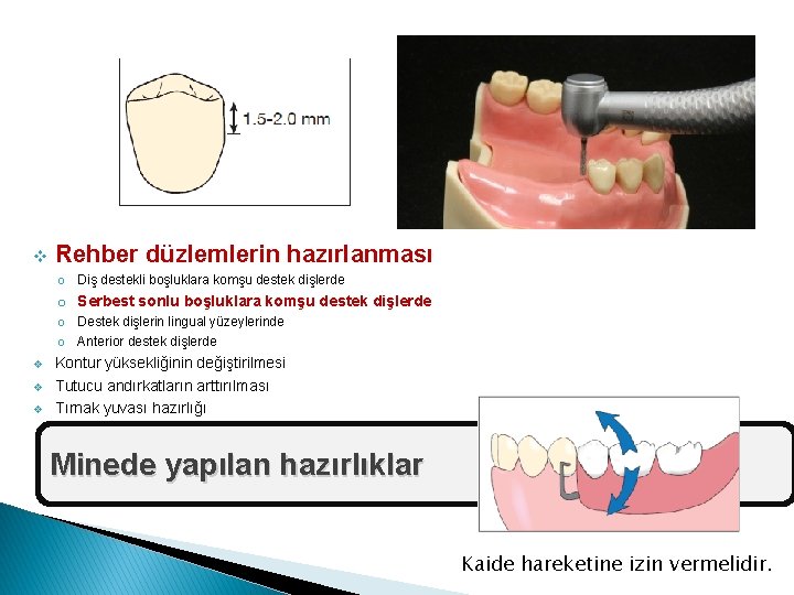 v Rehber düzlemlerin hazırlanması o Diş destekli boşluklara komşu destek dişlerde o Serbest sonlu