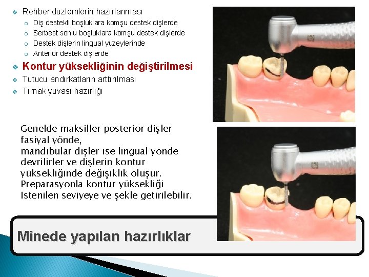 v Rehber düzlemlerin hazırlanması o o Diş destekli boşluklara komşu destek dişlerde Serbest sonlu