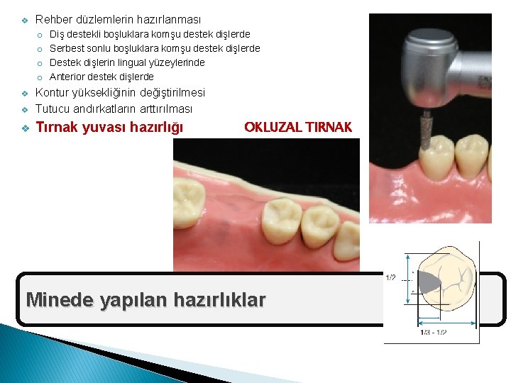 v Rehber düzlemlerin hazırlanması o o Diş destekli boşluklara komşu destek dişlerde Serbest sonlu