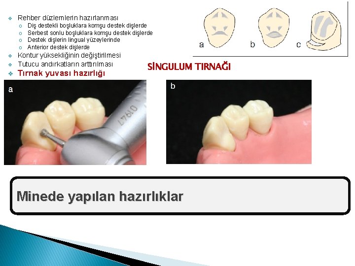 v Rehber düzlemlerin hazırlanması o o Diş destekli boşluklara komşu destek dişlerde Serbest sonlu
