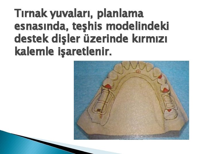 Tırnak yuvaları, planlama esnasında, teşhis modelindeki destek dişler üzerinde kırmızı kalemle işaretlenir. 