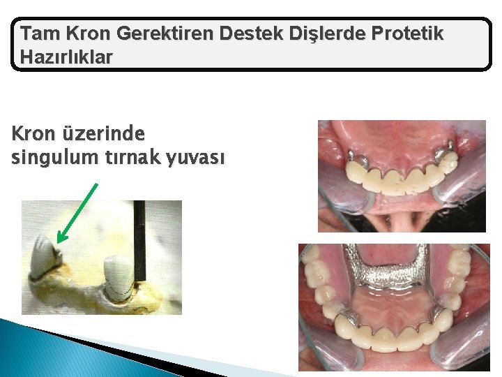 Tam Kron Gerektiren Destek Dişlerde Protetik Hazırlıklar Kron üzerinde singulum tırnak yuvası 