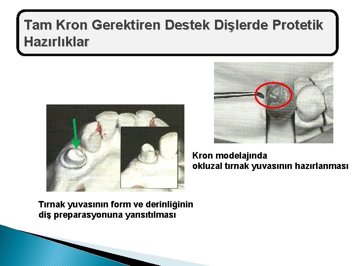 Tam Kron Gerektiren Destek Dişlerde Protetik Hazırlıklar Kron modelajında okluzal tırnak yuvasının hazırlanması Tırnak