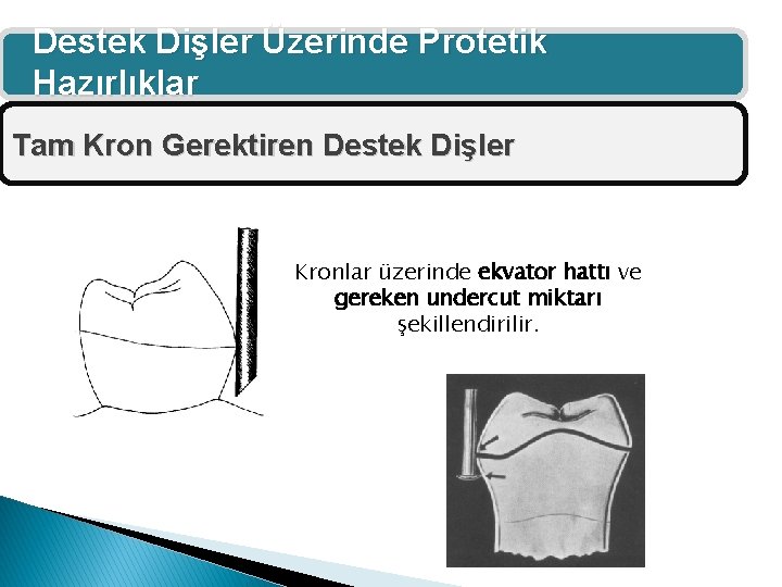 Destek Dişler Üzerinde Protetik Hazırlıklar Tam Kron Gerektiren Destek Dişler Kronlar üzerinde ekvator hattı