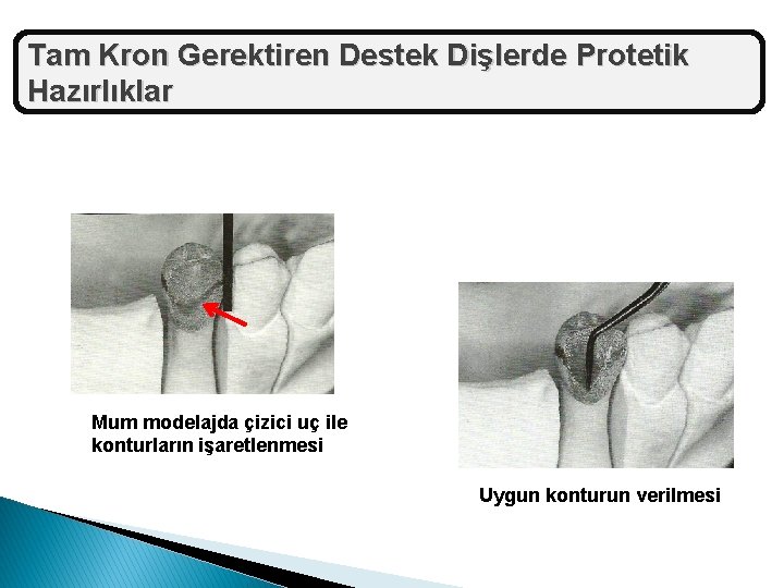 Tam Kron Gerektiren Destek Dişlerde Protetik Hazırlıklar Mum modelajda çizici uç ile konturların işaretlenmesi