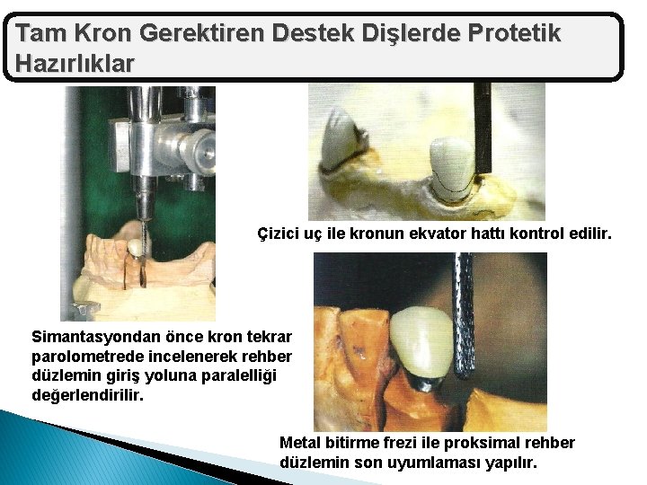 Tam Kron Gerektiren Destek Dişlerde Protetik Hazırlıklar Çizici uç ile kronun ekvator hattı kontrol