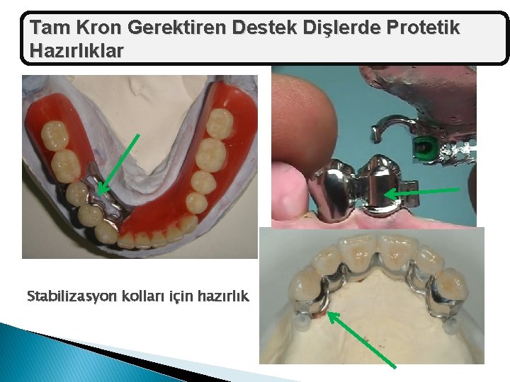 Tam Kron Gerektiren Destek Dişlerde Protetik Hazırlıklar Stabilizasyon kolları için hazırlık 