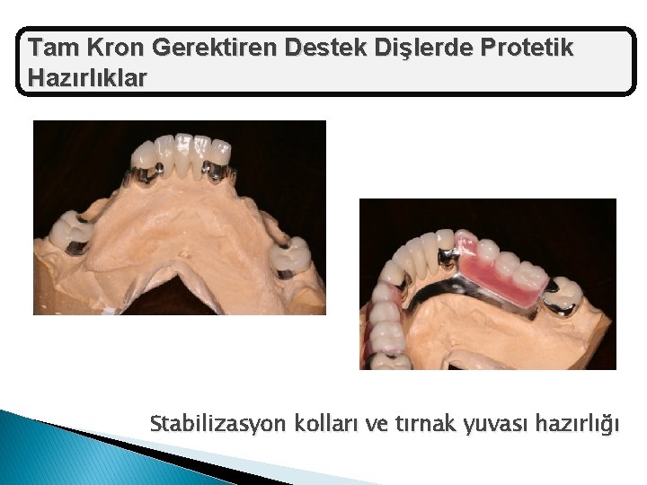 Tam Kron Gerektiren Destek Dişlerde Protetik Hazırlıklar Stabilizasyon kolları ve tırnak yuvası hazırlığı 