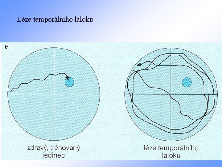 Léze temporálního laloku 