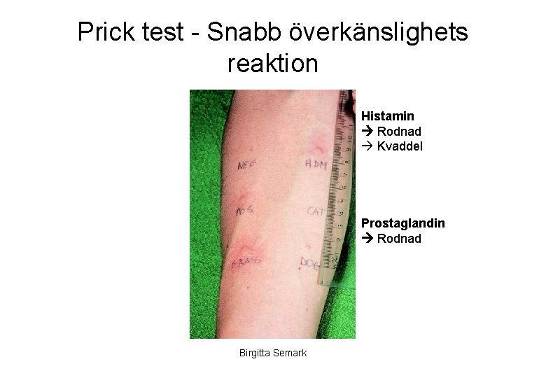 Prick test - Snabb överkänslighets reaktion Histamin Rodnad Kvaddel Prostaglandin Rodnad Birgitta Semark 