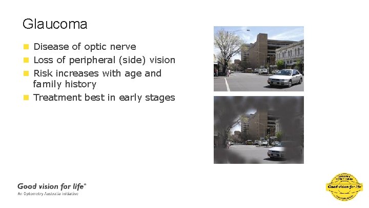 Glaucoma n Disease of optic nerve n Loss of peripheral (side) vision n Risk