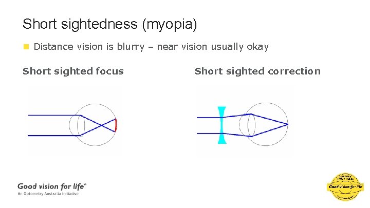 Short sightedness (myopia) n Distance vision is blurry – near vision usually okay Short