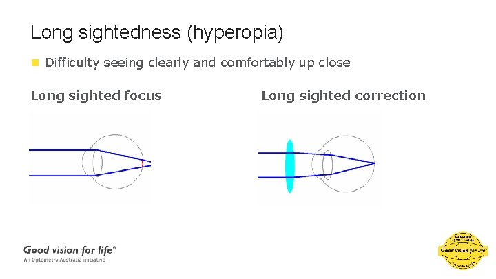 Long sightedness (hyperopia) n Difficulty seeing clearly and comfortably up close Long sighted focus